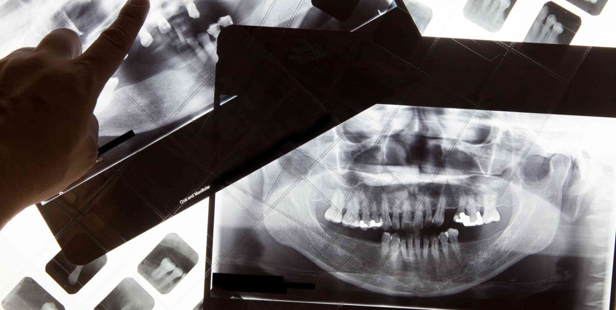 Pantomogram: Co to jest i dlaczego jest ważne w diagnostyce stomatologicznej?